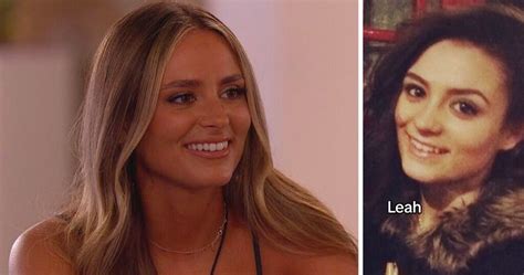 kenzie love|mackenzie love island before surgery.